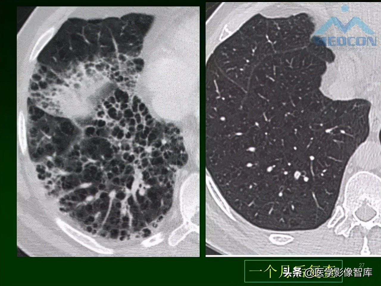 肺弥漫性网状影,两肺小叶间隔增厚可见网状模糊影