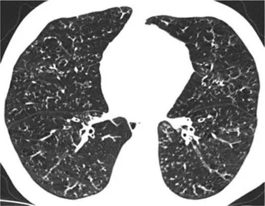 间质性肺疾病看病经验分享,分享肺腺癌临床实验的例子