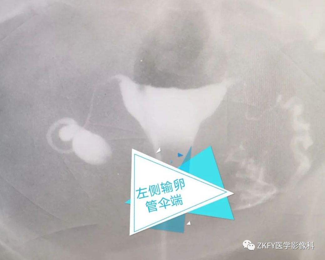 子宫输卵管造影术,子宫输卵管造影术包括哪些项目