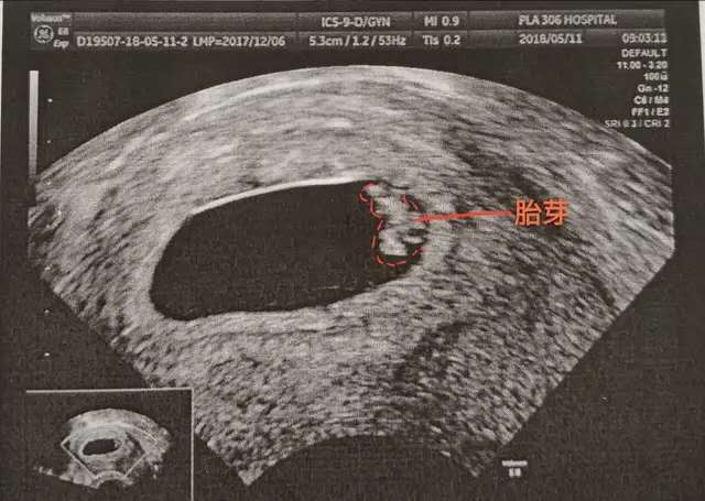 怀孕多久做B超比较好,怀孕多久做b超可以查到孕囊