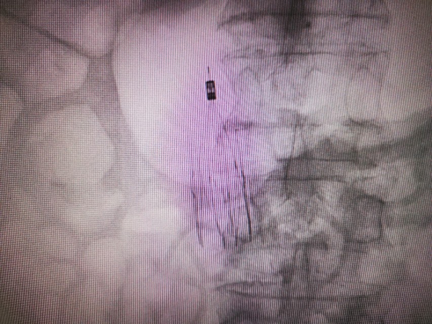 小腿发痒要警惕静脉曲张,小腿深静脉血栓的治疗方法是什么