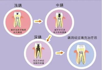 老是牙疼怎么办最快最有效,总是牙疼吃什么药好得快