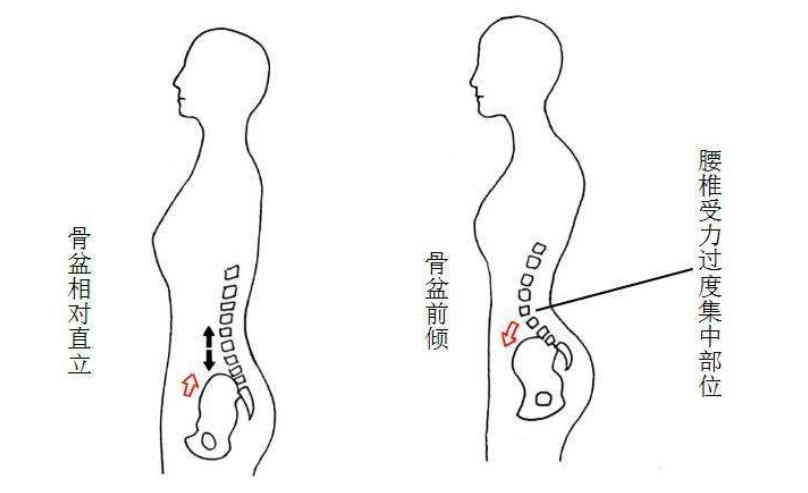 治疗骨盆前倾引起腰痛的锻炼方法,骨盆前倾腰疼纠正最快的方法