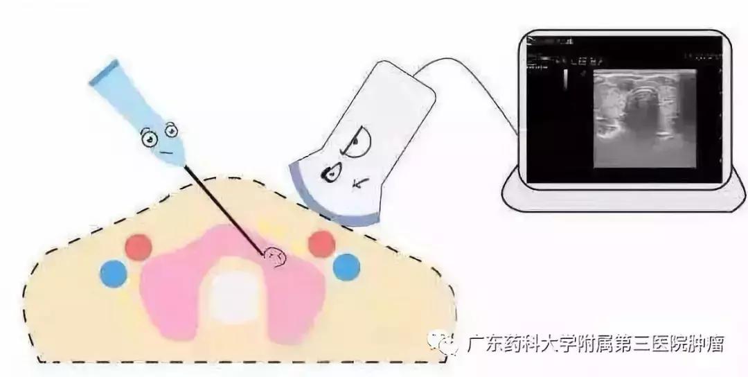 消融法治疗恶性肿瘤的疗效,消融术是消融良性还是恶性肿瘤