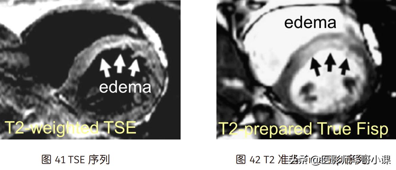 心脏mr增强扫描讲解,磁共振心脏扫描标准切面