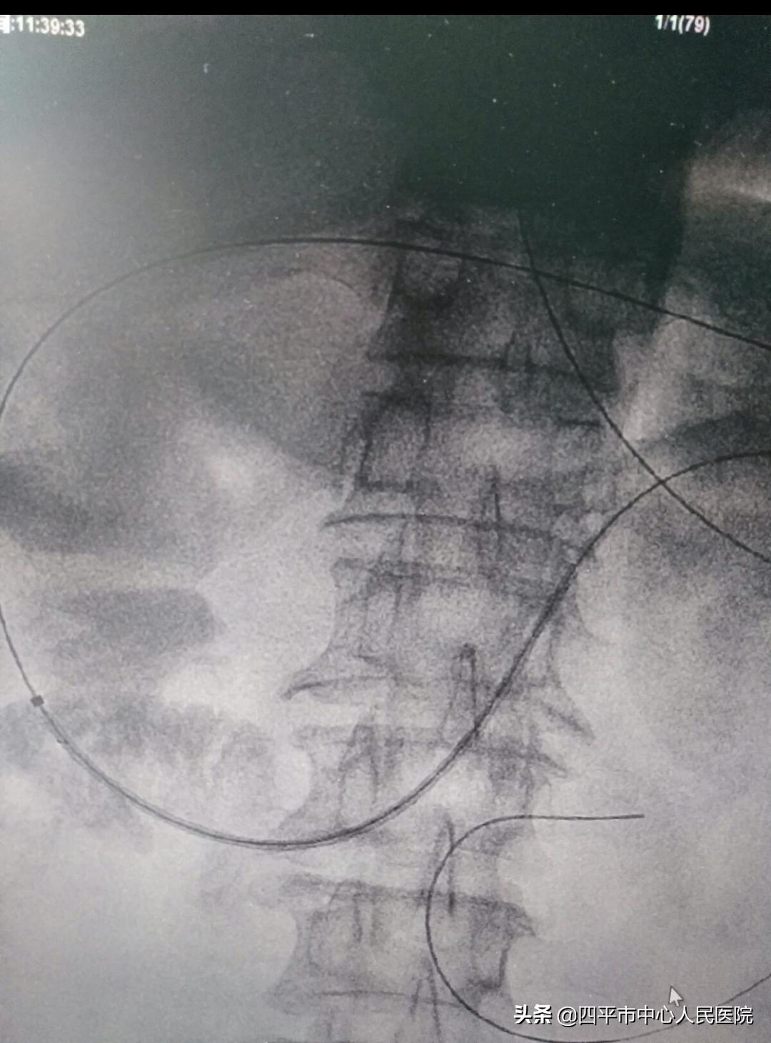 多学科联合手术救治患者,多学科联合抢救病人