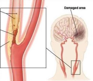 成年人脑梗继发癫痫最佳治疗方法,脑梗死癫痫部分发作