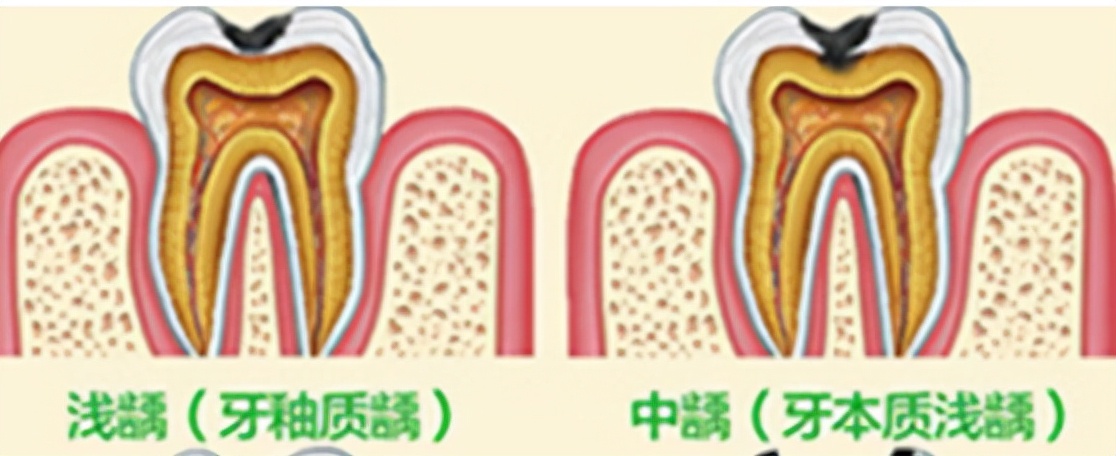 牙齿残根疼痛时可以拔掉吗,牙齿轻微疼痛可以去治疗吗