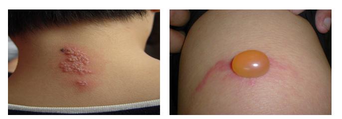 皮肤病蛇缠腰是什么症状,手部常见皮肤病的症状及治疗