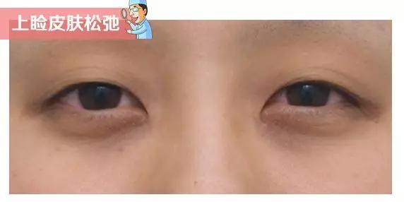 有眼袋黑眼圈法令纹怎么办,黑眼圈泪沟法令纹高光