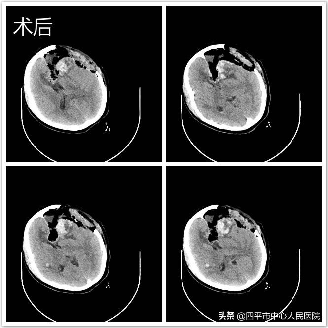 再创生命奇迹——神经外科成功救治白血病继发脑出血病危患者