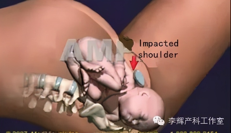 阴式分娩（自然分娩）知情同意书的专业解读