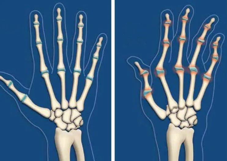 疫情期间，类风湿性关节炎急性发作应这样处理，否则追悔莫及
