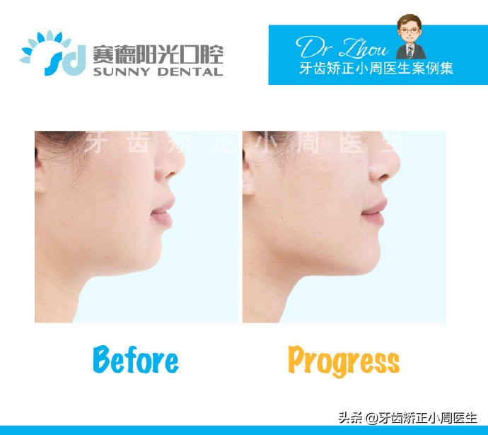 下巴后缩整容玻尿酸还是假体,如何不靠整容改变下巴