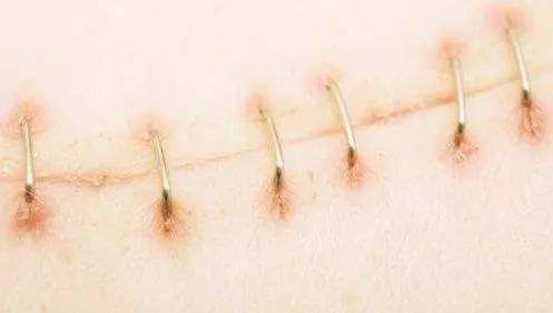 伤口美容缝合跟普通缝合比较图,皮肤缝合的手法