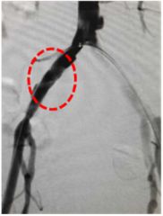 举例科普|介入能治疗哪些疾病?