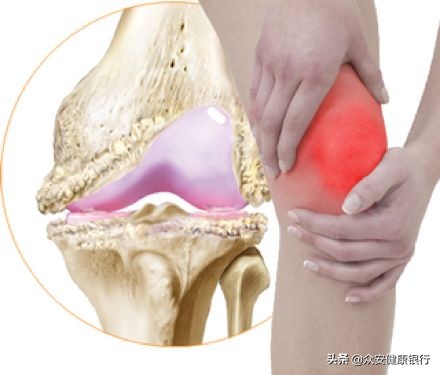 oa骨关节炎,骨性关节炎oa是什么意思