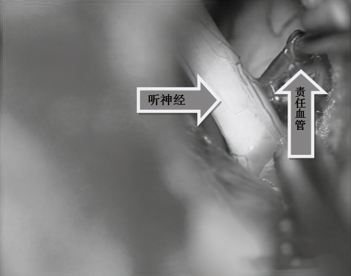 女子多年耳鸣被中医治好,55岁女耳鸣一年多不影响睡眠