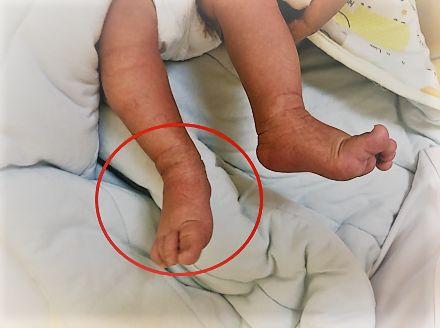 孩子足外翻与足内翻怎么办呢,足内翻和足外翻按摩什么穴位