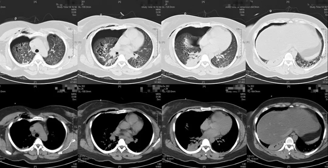 女性气胸的十大症状,女性气胸的十个表现