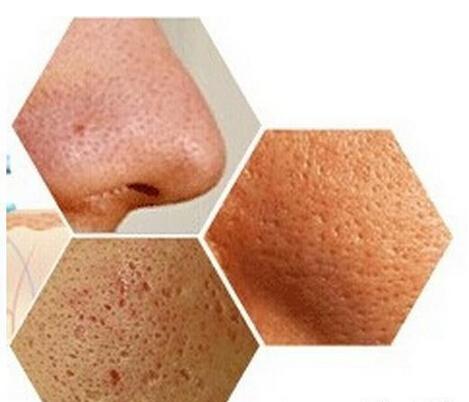 郭鸿财：皮肤毛孔粗大，影响着脸部的美观，这个该怎么改善呢？