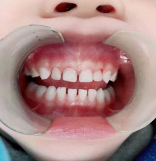 乳牙龋齿治疗会痛吗,三岁多宝宝牙齿龋齿严重怎么治疗