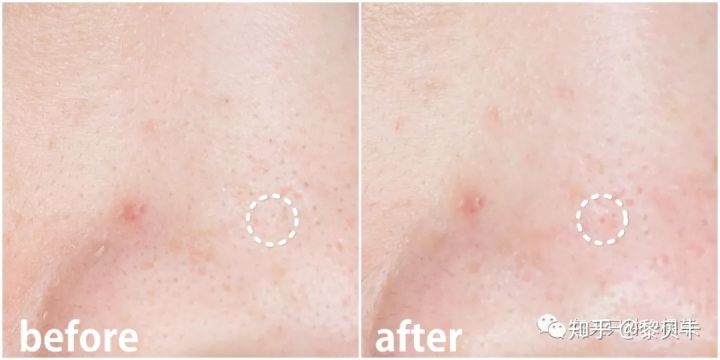 黑头去除神器排行榜,黑头粉刺清除强力推荐网红产品