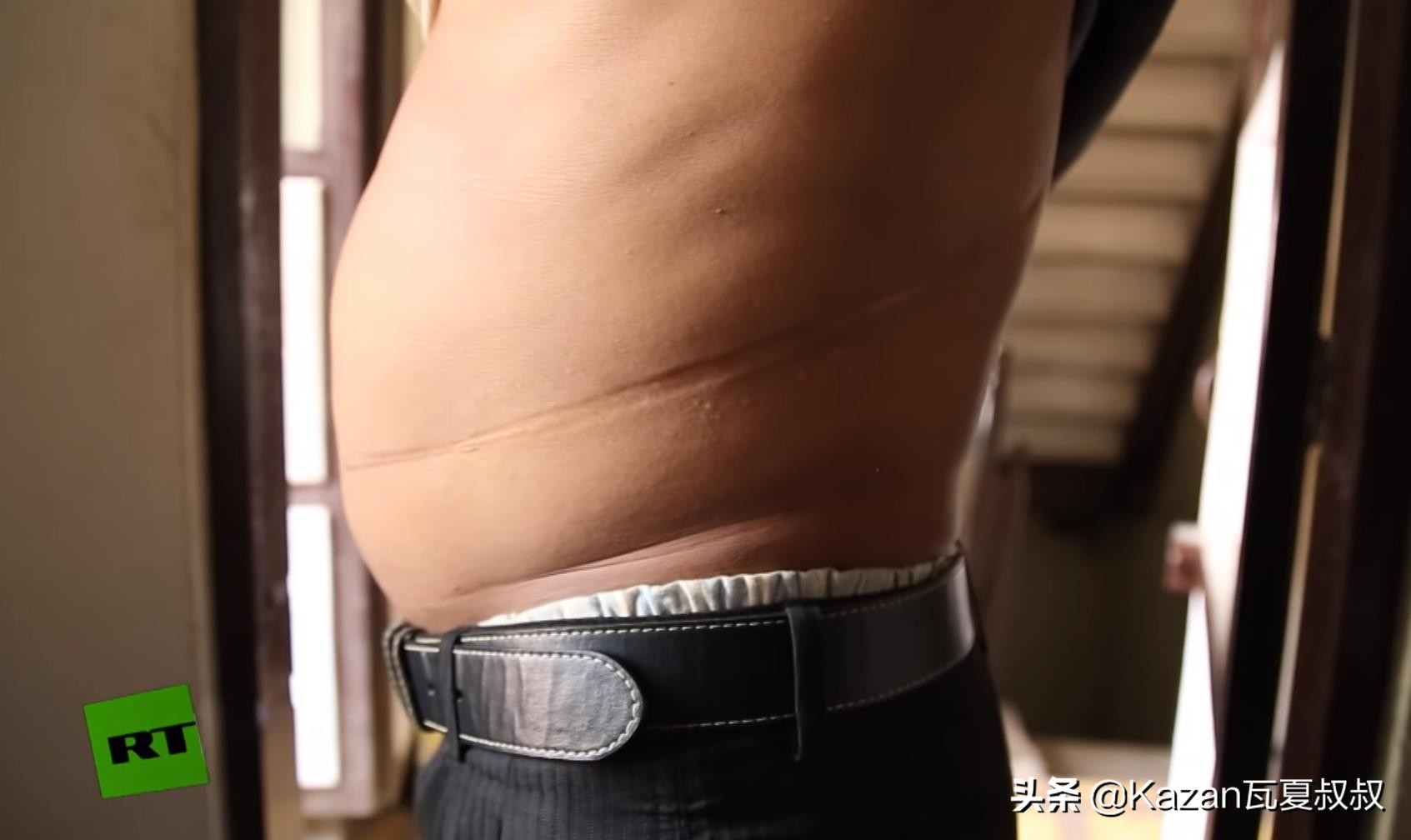 尼泊尔“卖肾村”，穷人们以500美元“高价”和*市黑**做交易换钱