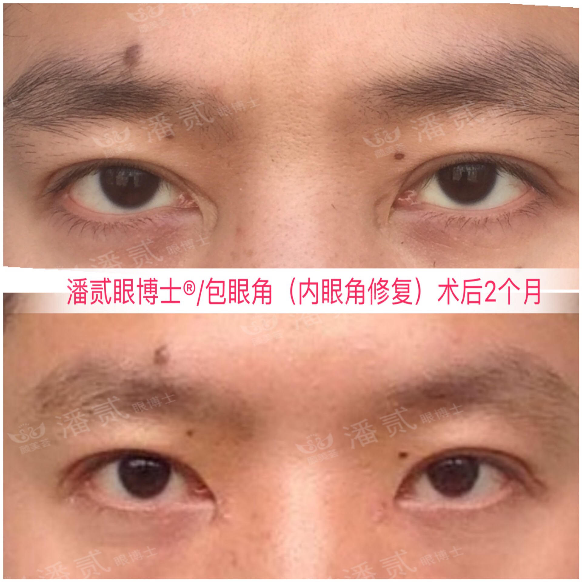 开内眼角会留疤的照片,开内眼角的疤痕变白色了怎么办