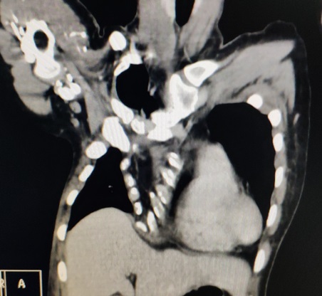 胸廓畸形矫正术后恢复,再创奇迹