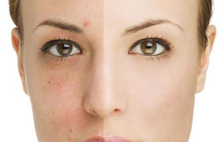 t区闭口粉刺反复长怎么办,额头反复起闭口粉刺怎么回事