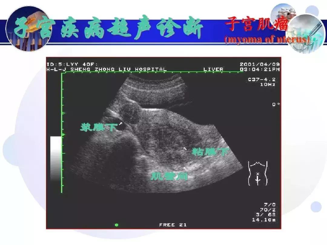 纯干货！子宫及附件解剖和超声诊断