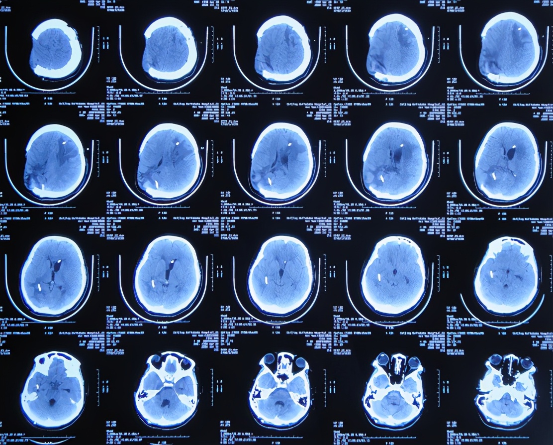 脑室有粘连脑积水有什么办法,脑动脉畸形手术后出现急性脑积水