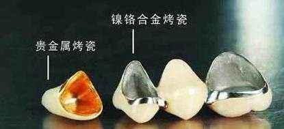 我的烤瓷牙为什么那么厚,我的烤瓷牙脱落怎么办