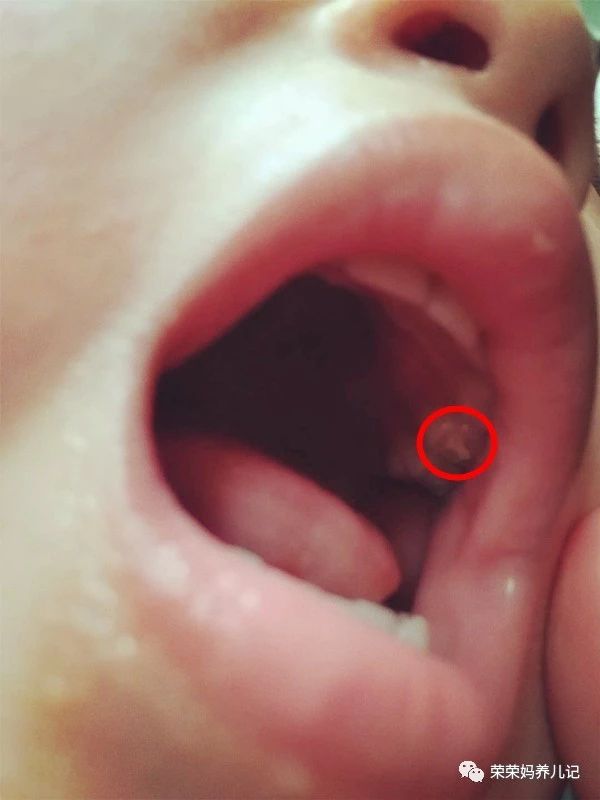 窝沟封闭预防龋齿会有什么危害吗,窝沟封闭后将有效预防孩子龋齿