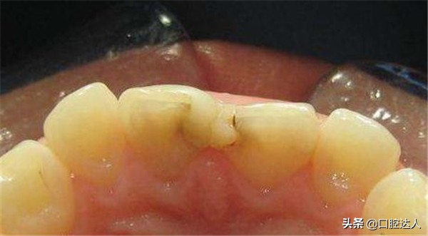 补过的牙几年后突然又疼了怎么治,补了几年的牙突然疼痛要如何解决