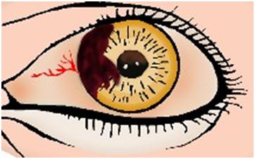 眼睛受外伤的紧急处理办法,眼睛化学烧伤急救办法