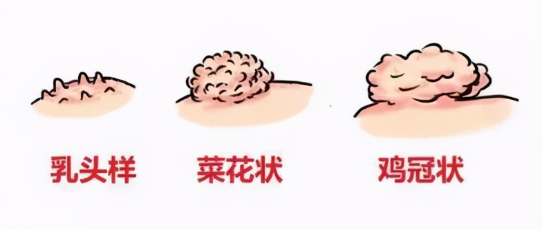 丁丁上怎么长了“小疙瘩、小红点”？难道是染上了性病？