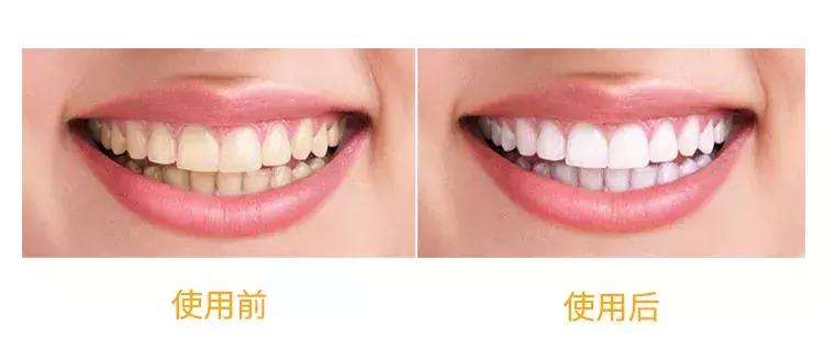 一口黄牙影响颜值,一口黄牙齿