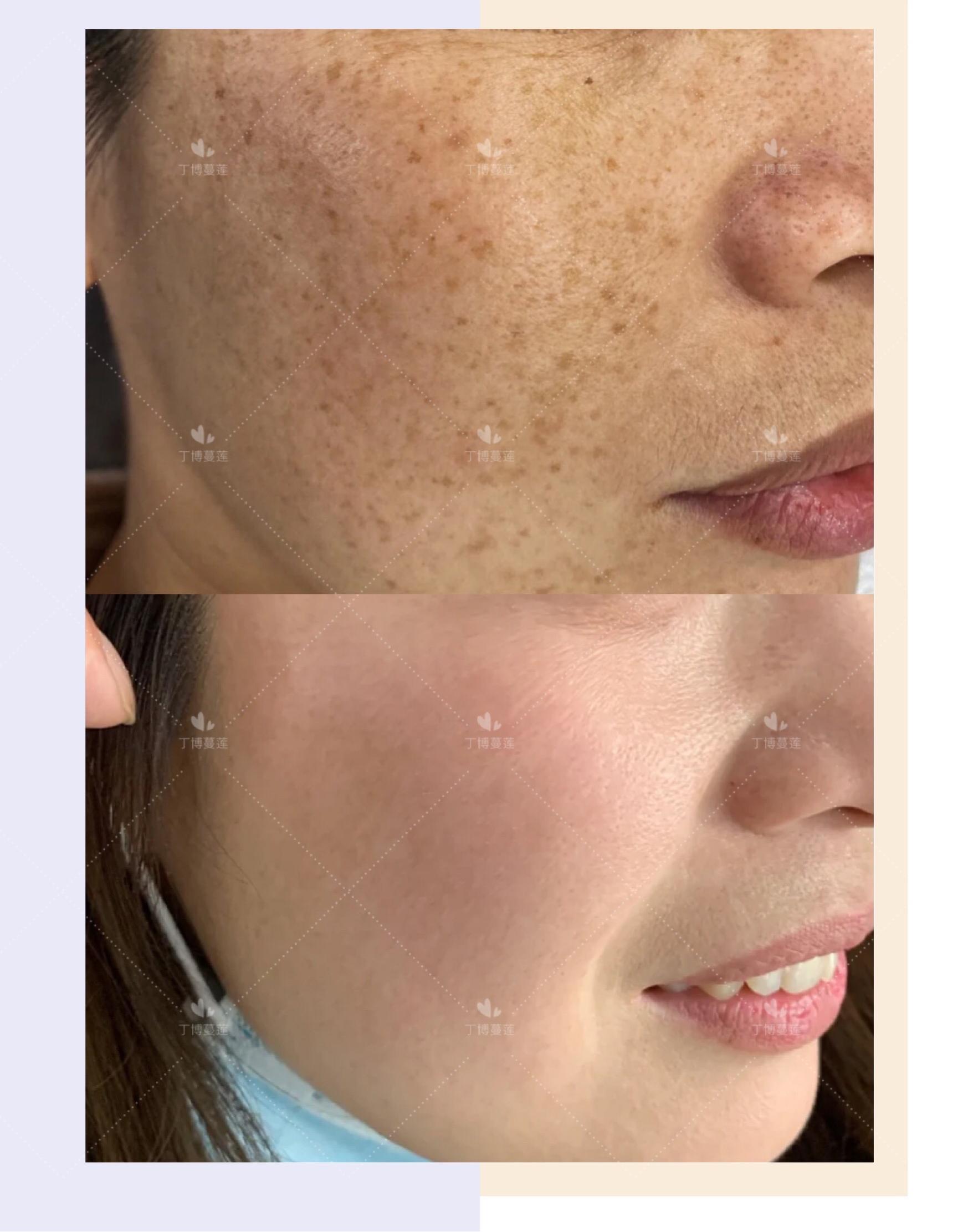 雀斑真的无药可救了吗,雀斑用中药真的能去除吗