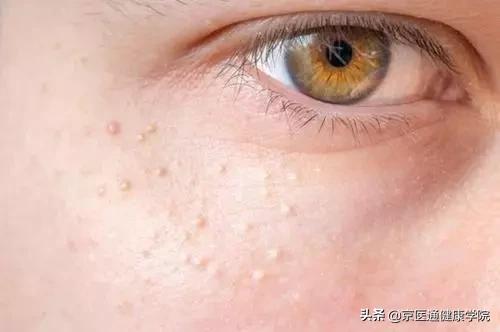 粟丘疹与汗管瘤脂肪粒去除小妙招,粟粒疹扁平疣
