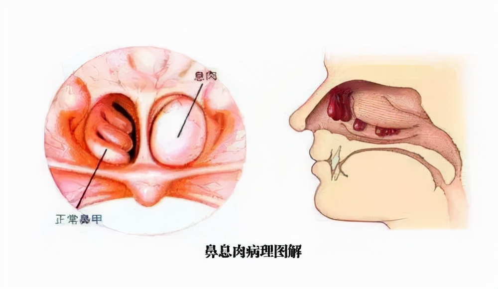 鼻息肉科普视频,健康科普带你了解什么是鼻息肉