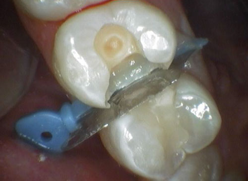 补牙有哪些流程,补牙以后需要注意什么