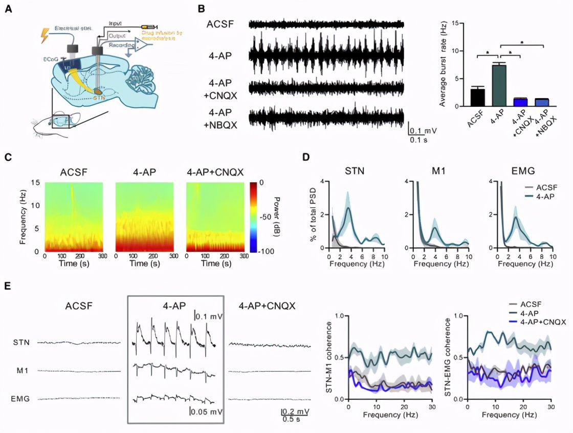 帕金森患者典型的震颤,帕金森病震颤的神经环路机制