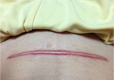 剖腹产疤痕越来越大有危害吗,剖腹产疤痕会导致不孕吗