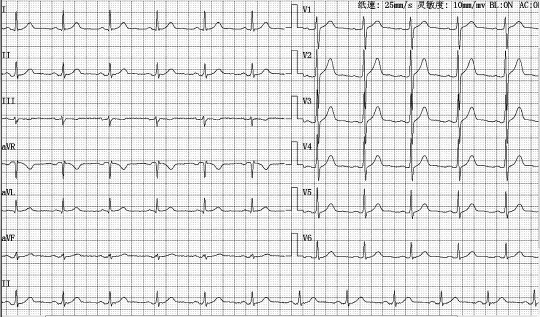 心肌梗死两年心电图正常怎么回事,心电图检查心肌梗死心肌酶正常