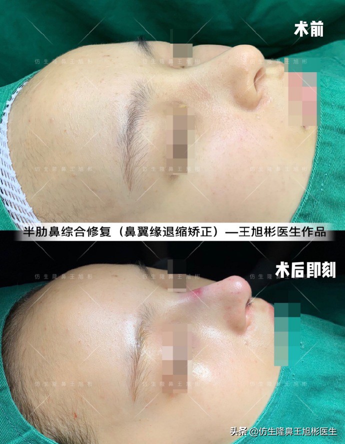 隆鼻的鼻翼怎么修复,隆鼻后多久可以做鼻翼缘矫正