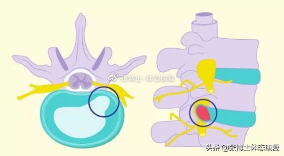 颈椎间盘突出拉筋康复训练,运动医学颈椎康复训练动作