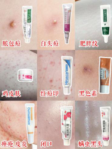 痘坑黑头药膏,祛黑头痘痘闭口疤痕的药膏