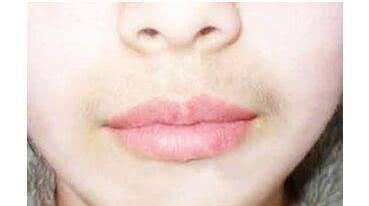 女生唇毛刮胡子会越刮越粗吗,胡子和唇毛多怎样消除